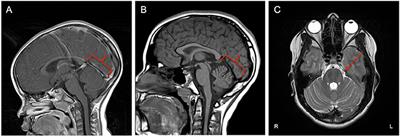 A Chromosomal Deletion and New Frameshift Mutation Cause ARSACS in an African-American